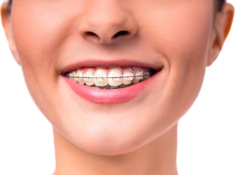 Adult Braces - Smile Every Day Orthodontics - Adult Teeth Straightening
